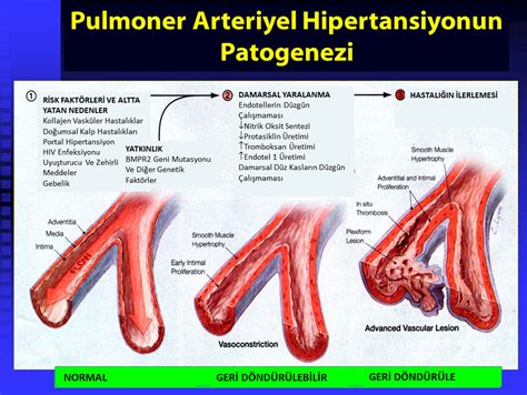 pulmoner hipertansiyon nedenleri